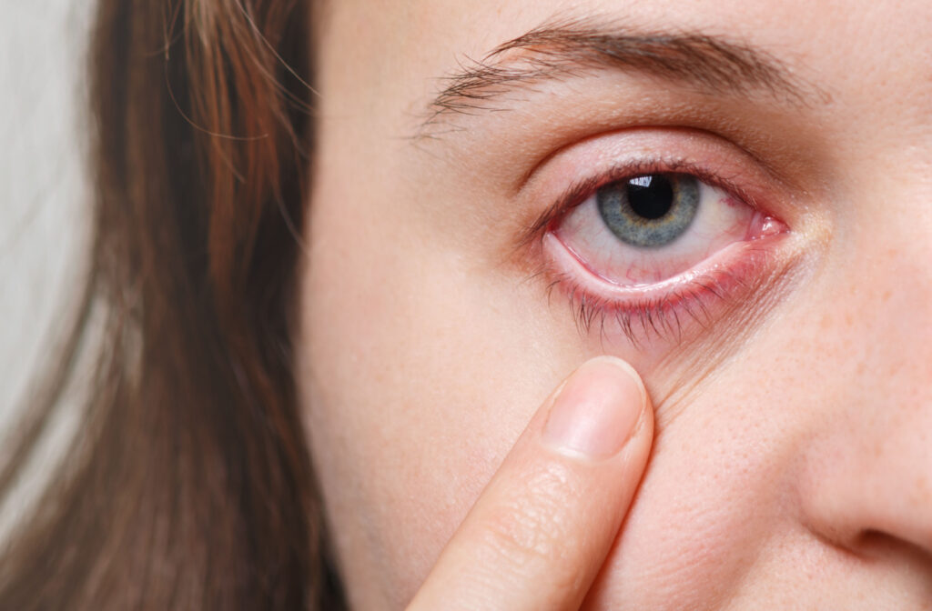 A close-up of a woman's inflamed eye, suffering from blepharitis.