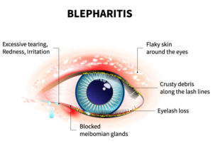 Understanding Blepharitis | Stoney Creek Eye Care