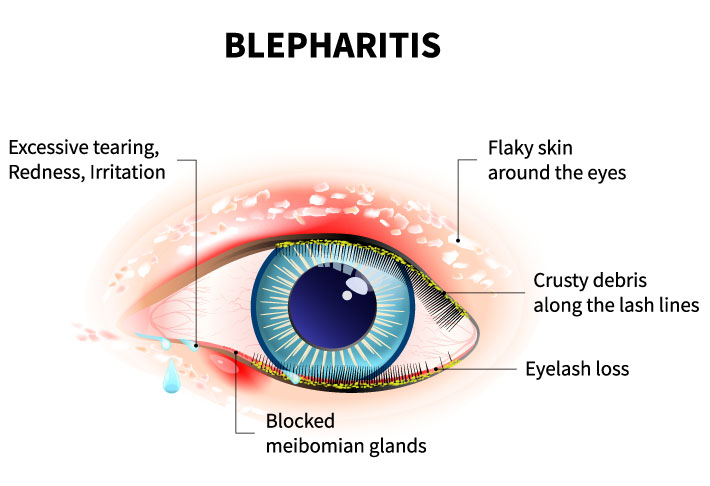 eyelid disease blepharitis