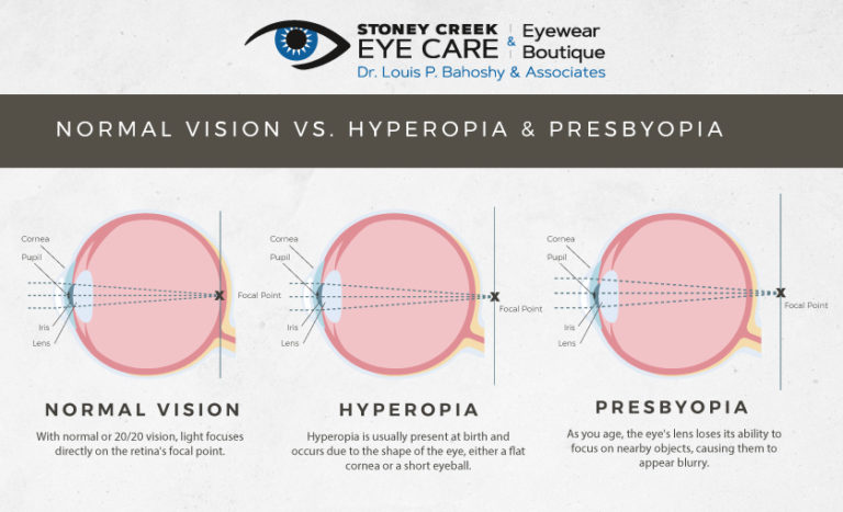 Everything You Need To Know About Presbyopia Stoney Creek