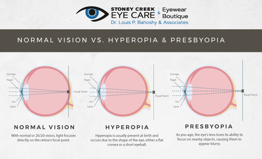 diagram comparing normal vision to hyperopia and presbyopia