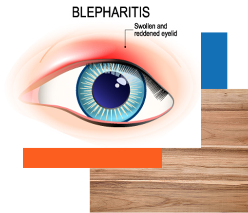 seborrheic blepharitis treatment