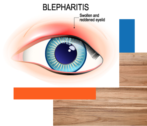 Blepharitis (Eyelid Inflammation): Causes & Treatment