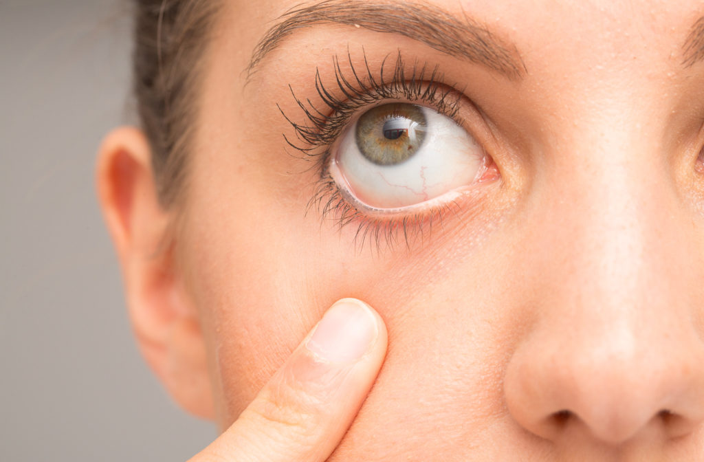 girl with green eyes holding her eye open to relieve symptoms of dry eye