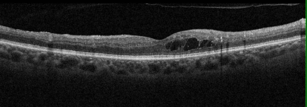 dry macular degeneration oct