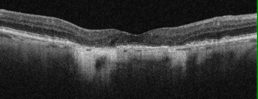 macular degeneration oct