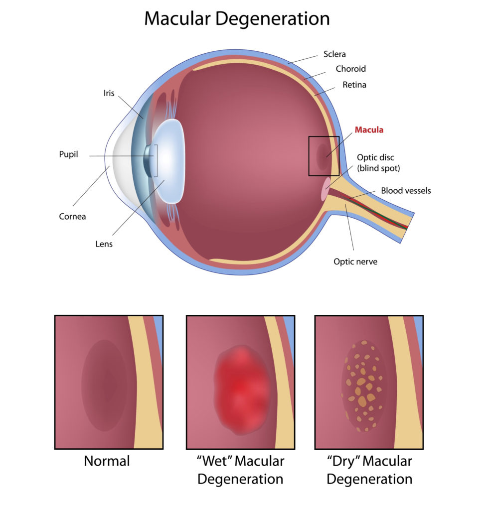 Diagram comparing a healthy macula with wet AMD and dry AMD