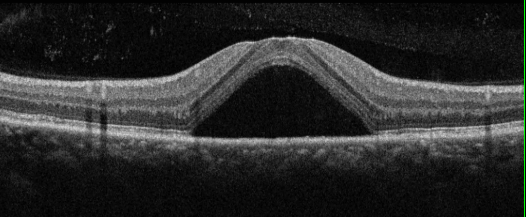 What is Optical Coherence Tomography (OCT)?