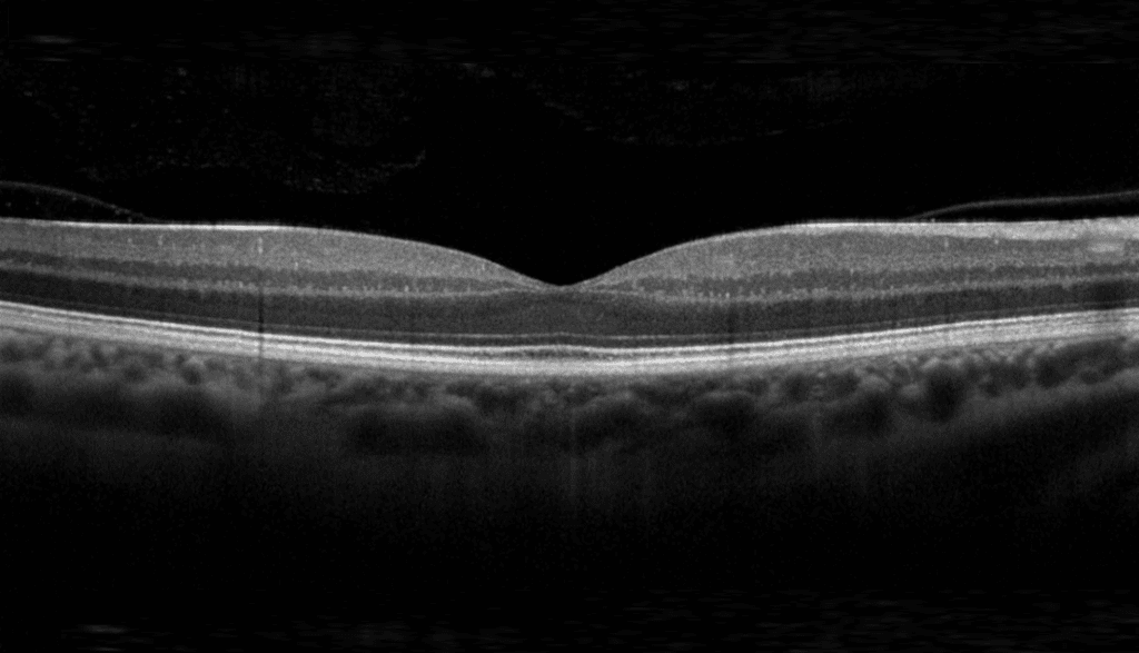 Oct Image Of Retina