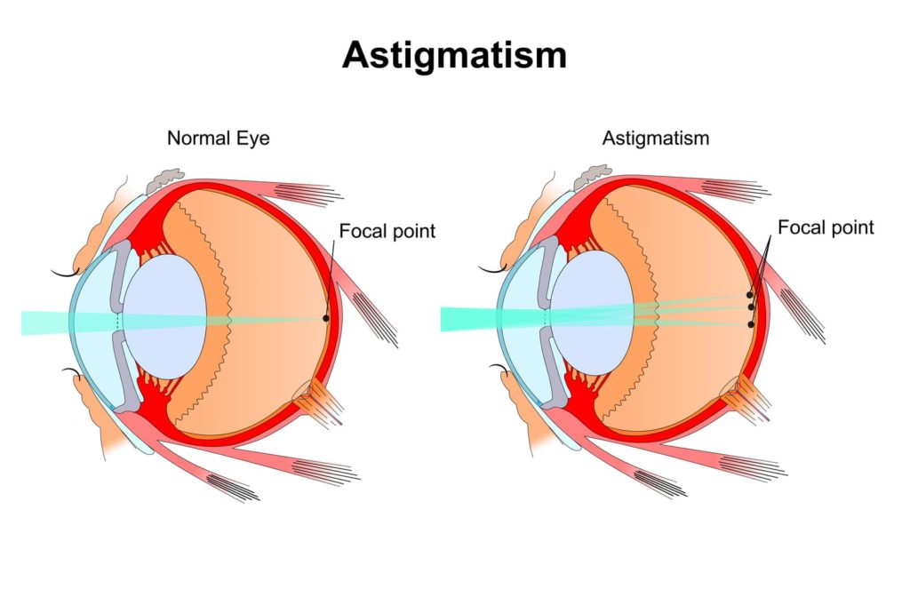 Diagram showing how astigmatism affects the focal point on the eye