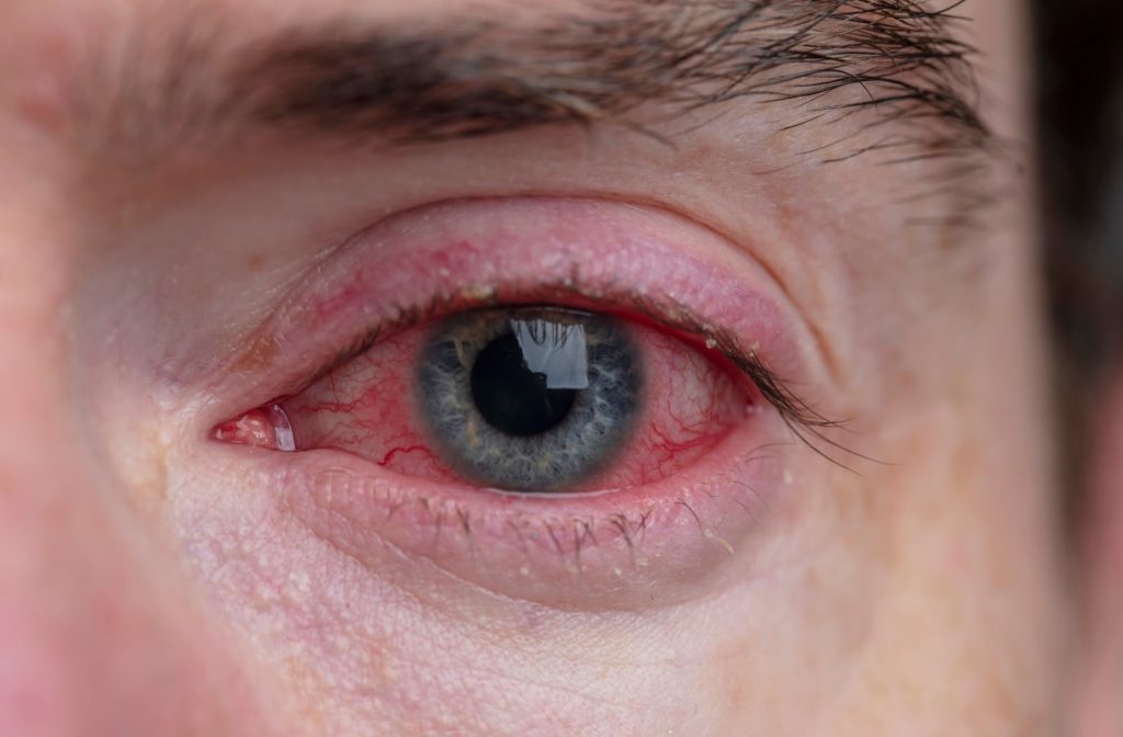 Man with blepharitis in his right eyes