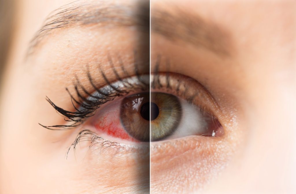 Comparison of woman with dry eye on the left and with no dry eyes on the right.