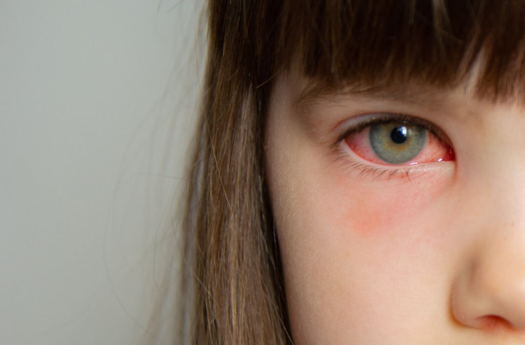 A close-up eye of a young girl with an eye infection, red and irritated eyes after rubbing an eye.