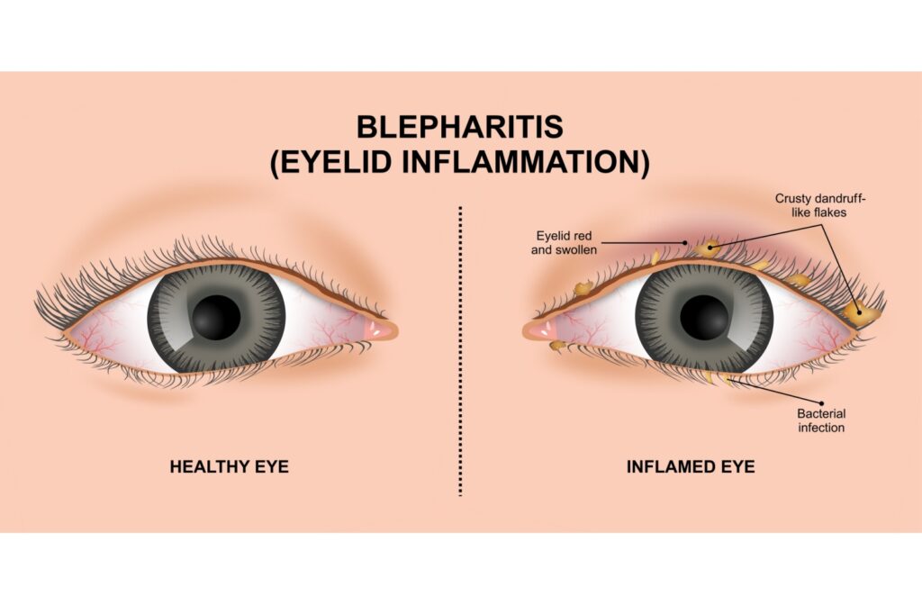 Medical illustration comparing a healthy eye and an inflamed eye with blepharitis (eyelid inflammation). The healthy eye has a smooth eyelid without debris. The inflamed eye shows red and swollen eyelid, crusty dandruff-like flakes on the eyelashes, and signs of bacterial infection.