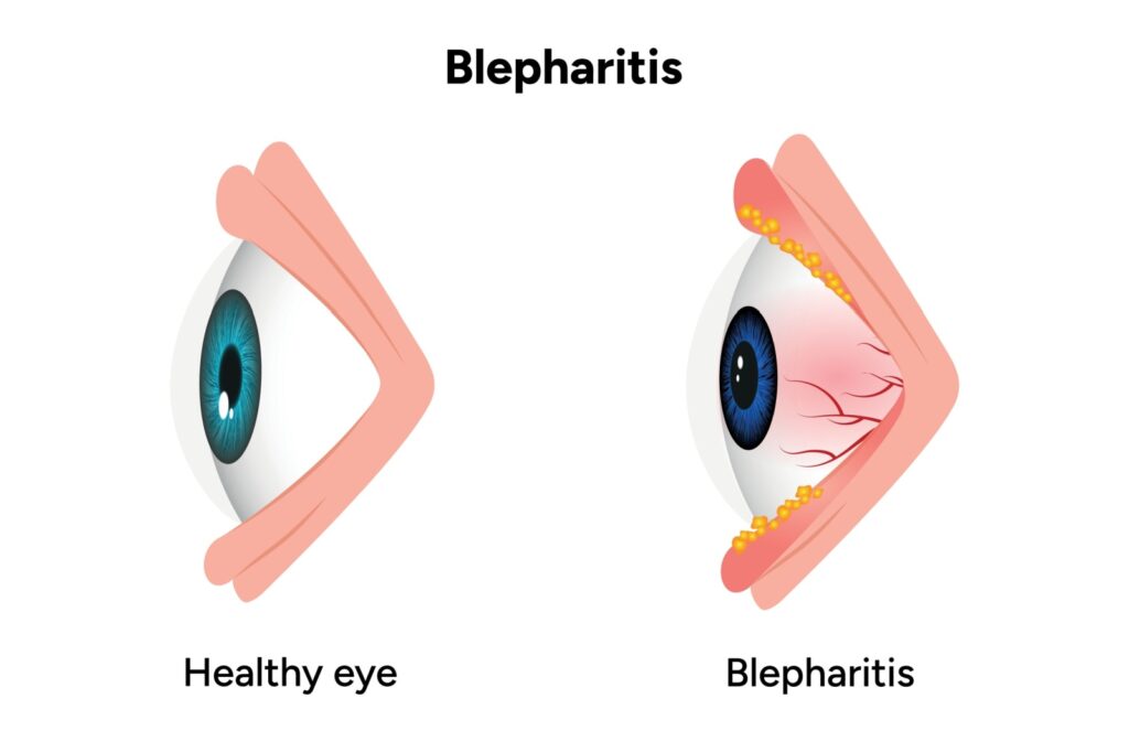 Side view medical illustration comparing a healthy eye and an eye with blepharitis. The healthy eye appears clear with smooth eyelids, while the blepharitis eye shows redness, swollen eyelids, visible blood vessels, and yellow crusty deposits along the eyelid margins.