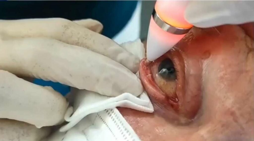 Jett Plasma Pen treatment being performed on lower eyelid with silver tip applicator for dry eye and meibomian gland dysfunction therapy.