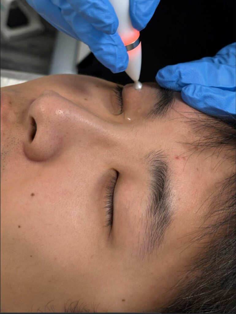 Patient receiving non-ablative Jett Plasma Pen treatment on upper eyelid area with conductive gel for MGD and blepharitis.